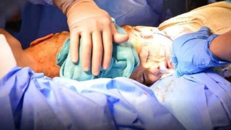 ولادة توأم غريب بأكادير:رأس الذكر ملتصق ببطن الأنثى وقلق وسط الأطباء ولادة توأم غريب بأكادير:رأس الذكر ملتصق ببطن الأنثى وقلق وسط الأطباء