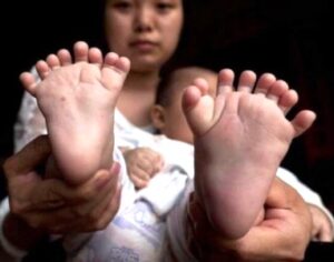 (+صورة). ولادة طفل لديه 31 إصبعا بيديه ورجليه ولا أصابع إبهام..