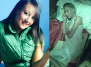 وزير يدخل على خط قضية الفتاة الجميلة التي حول السرطان جسدها إلى هيكل عظمي