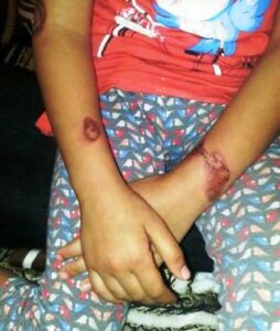 خطير:(+صور). “أم” بأكادير تعدب ابنتها بطريقة وحشية