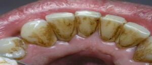 هذه أسهل طريقة فعالة لإزالة الرواسب البيكتيرية من باطن أسنان الفم