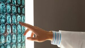 دراسة: السمنة تسرع شيخوخة الدماغ بـ10 سنوات!