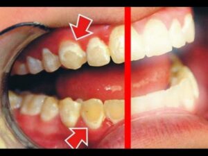 فاكهة تقضي نهائياً على تسوس الأسنان والتهاب اللثة