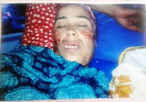 +صورة:”ضربة رأسية” ترسل مستشارة بأكادير إلى الغيبوبة 6ساعات،و تسبب لها في سقوط 3 أسنان