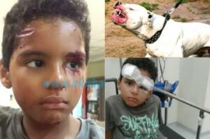شاهد كلب “بيتبول” مزق وجه طفل صغير بالدار البيضاء