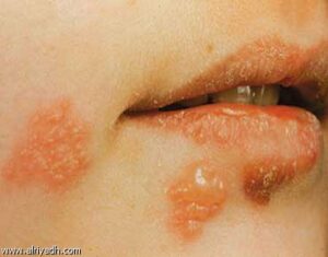 عشر حقائق عن الأمراض المنقولة جنسياً …اخطرها هذه: