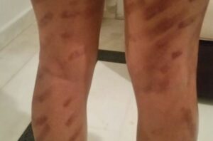 عملية تجميلية لإزالة الشعر  تحول جسد نادية من أكادير إلى شوارع من الحروق الخطيرة