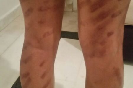 عملية تجميلية لإزالة الشعر تحول جسد نادية من أكادير إلى شوارع من الحروق الخطيرة