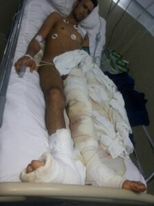 شاب يرقد بمصحة خاصة بأكادير يناشدكم لإنقاد رجله من “البثْر” (صورة صادمة)