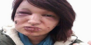 حتى لا ينظر إليها رجل آخر، شاب يعضّ صديقته 21 مرة من وجهها !!