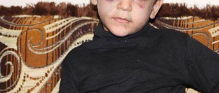 طفل يتيم يتعرض لاعتداء وحشي على يد زوجة أبيه والأخير يتستر على القضية لإرضاء لزوجته