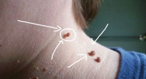 لكل شخص يعاني من هذه الزوائد لن تصدق كيف تتخلص منها بسهولة وفي يوم واحد