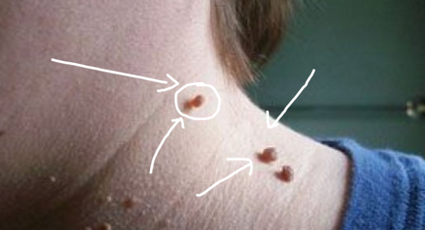 لكل شخص يعاني من هذه الزوائد لن تصدق كيف تتخلص منها بسهولة وفي يوم واحد