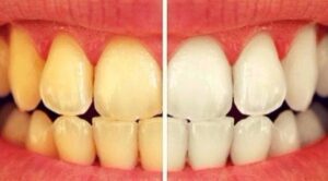 10 أطعمة ومشروبات تؤدي إلى اصفرار أسنانك