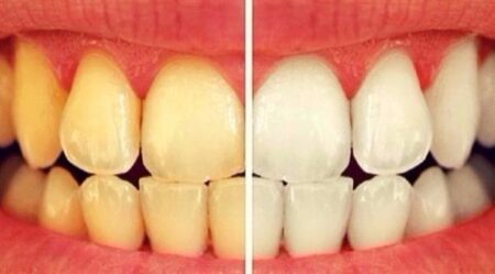 10 أطعمة ومشروبات تؤدي إلى اصفرار أسنانك