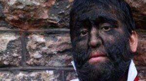 “الرجل الذئب” و”الرجل الشجرة”…أمراض نادرة ولكنها حقيقة