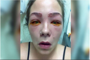 خطير .. أرادت صبغ حاجبيها وكانت النتيجة حروق كادت تعصف ببصرها