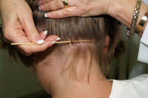 “القمل” يجتاح المدارس عبر 12 ولاية بالجزائر في ظرف أسبوع ومخاوف من ”تصديره” للمغرب