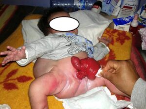 المديرية الجهوية للصحة بسوس ماسة تكشف معطيات جديدة بخصوص الوضعية الصحية للرضيع سعد الذي ولد بدون مخرج حرمه من البراز الطبيعي