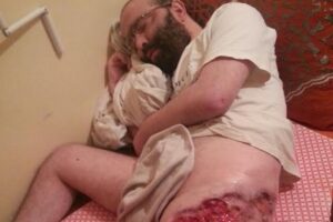 ناذر بإنزكان: مرض غريب يصيب فخد مواطن و يحوله  إلى رقعة من “الحفر” بعد أن تسّاقط لحمه.