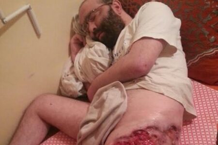 ناذر بإنزكان: مرض غريب يصيب فخد مواطن و يحوله إلى رقعة من “الحفر” بعد أن تسّاقط لحمه. ناذر بإنزكان: مرض غريب يصيب فخد مواطن و يحوله إلى رقعة من "الحفر" بعد أن تسّاقط لحمه.