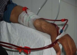 مافيا “دياليز” تهدد بقتل 1200 مريض