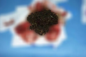 إخراج مئات المسامير من بطن مريض