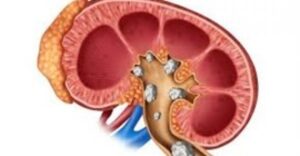 هذه هي المشروبات الطبيعية التي تساعد على تفتيت حصوات الكلى.