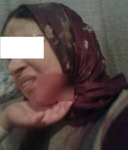 مسلسل الاعتداءات على نساء و رجال التعليم يتواصل: تلميذ آخر يمزق وجه أستاذته بسكين بعد مغادرتها المؤسسة(+صورة).