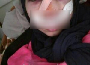 مسلسل الإعتداءات يتواصل على نساء و رجال التعليم، وهذه المرة أستاذة بتيزنيت تتعرض للكسر بحجر على  مستوى الأنف.