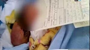 والد الطفلة التي وُلدت برأسين