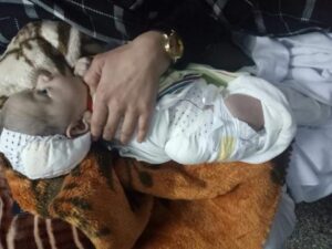 بالصورة:طفل يرقد بمستشفى أكادير يعاني من ورم غريب في الظهر يحتاج لاستئصاله