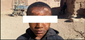 داء الليشمانيا يصيب 1700 شخص بزاكورة والسلطات تسارع الزمن لاحتواء الوضع