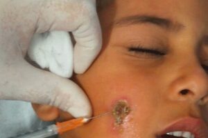 “أكثر من 7000 حالة إصابة بالليشمانيا بزاكورة”، و المرض اتسعت رقعته بشكل مخيف وسط التلاميذ