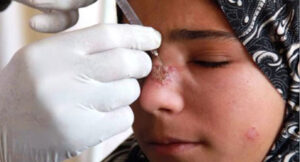 دعوات للاحتجاج بزاكورة بعد انتشار مرض الليشمانيا ووزارة الصحة تدخل على الخط