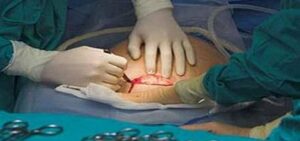 صادم: سيدة تلد بعملية قيصرية والطاقم الطبي بالمستشفى يترك “فوطة” ببطنها