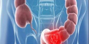 دراسة:التلفزيون لأكثر من 4 ساعات يوميا يعرض لزيادة خطر الإصابة بسرطان القولون والمستقيم