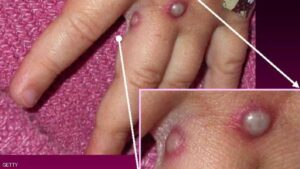 مرض قاتل يهدد البشرية ويحير العلماء،و هلع كبير من انتشاره