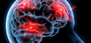 أخصائي في أمراض الجهاز العصبي يدق ناقوس الخطر:700 ألف مغربي مصابون بداء الصرع..وعدم العلاج يؤدي إلى الإعاقة