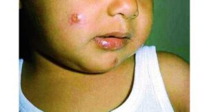 ظهور حالات جديدة مصابة بوباء “الليشمانيا” يستنفر مسؤولي الصحة بتيزنيت