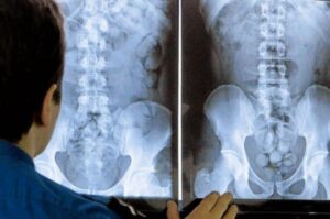 تفريغ ما يقارب 6 كيلو غرام  من الكوكايين من داخل أمعاء 5 مسافرين أجانب بمطار