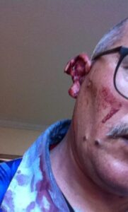 خطير وبالصور: عصابة باكادير تقطع أذن مسن بعد خروجه من وكالة بنكية، وتسلب منه بالقوة مبلغ 15 ألف درهم