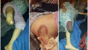 أكادير : سيدة تعاني من تعفنات خطيرة تناشد الجهات الوصية للتدخل لانقادها