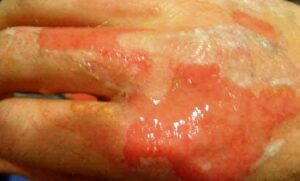 تيزنيت: قناديل البحر تحول أجسام المصطافين بشاطئ أكلو إلى خرائط من الحروق المصحوبة بآلام حادة.