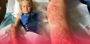 وشوم من الحناء بأكادير تحول حياة طفلين يحملان الجنسية الأنجليزية إلى جحيم، وكبريات الصحف تتخذ الموضوع مادة دسمة للنشر.