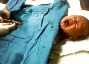 خطأ طبي يفقد طفلا عضوه التناسلي أثناء عملية الختان