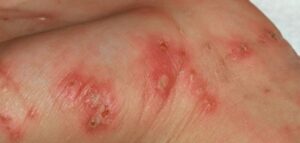 مدرسة تغلق أبوابها بسبب “الجربة” في صفوف التلاميذ والمدرسين والمسؤولين الإداريين