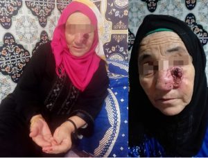 أكادير : سيدة من أعالي جبال ايموزار مصابة بورم في وجهها، تناشد المحسنين.