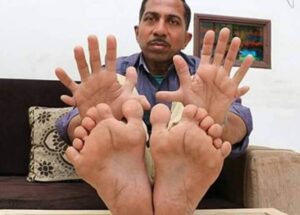 هندي يدخل غينيس لأنه يمتلك أكبر عدد أصابع في العالم 7 FB IMG 1637604628911