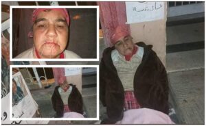 صادم.. خمسينية تخيط فمها احتجاجا على عدم منحها كشكا من طرف الجماعة